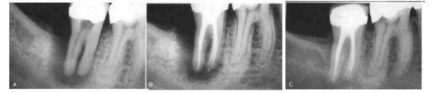 926_Radiographic Success of Root Canal Treatment.png