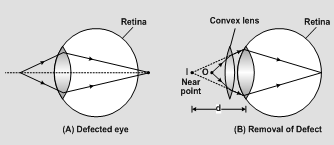 1026_defects in eye1.png