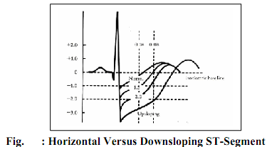 149_Show Upsloping ST-Segment.png