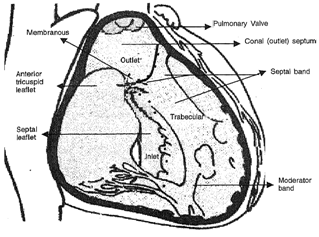 14_Ventricular septa1 defect.png