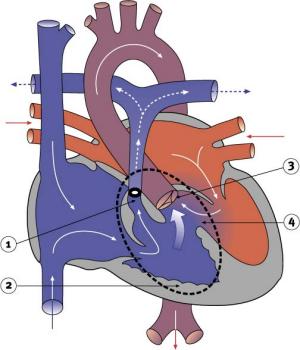 1660_Tetralogy_of_Fallot.jpg