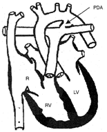 1675_Patent ductus arteriosus.png