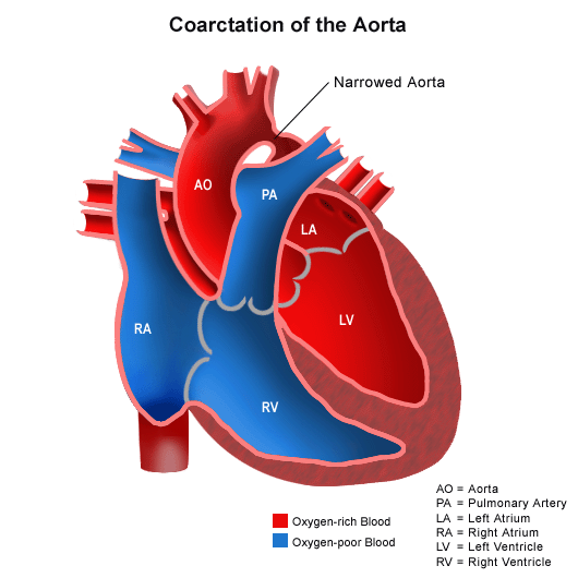 1688_125872_Coarctation of the Aorta.jpg.gif