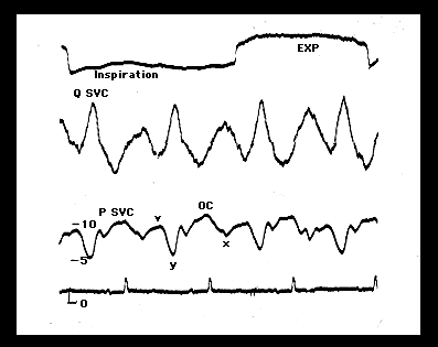 1764_Haemodynamic mechanisms in development of pulsus paradoxus.png