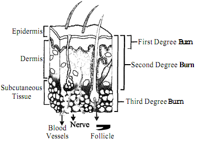 1968_First and second degree burns.png