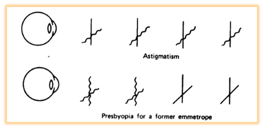 2004_Ametropia-Defective eyesight due to focusing 2.png