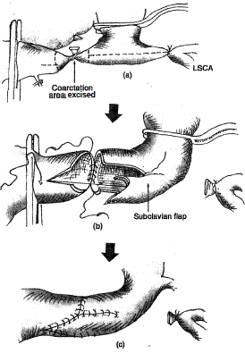 2250_End to end Anastomosis with Subclavian Flap Aortoplasty.png