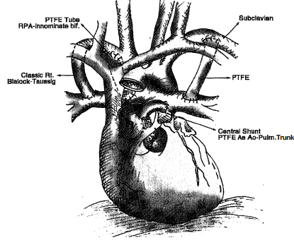 2274_Classic Blalock-Tanssig (BT) Shunt.png