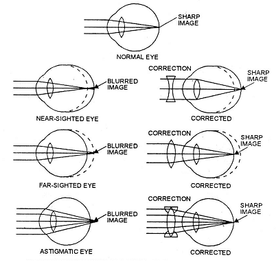 239_common eye defects.png