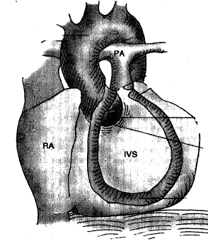 2486_Anatomical location of tetralogy.png