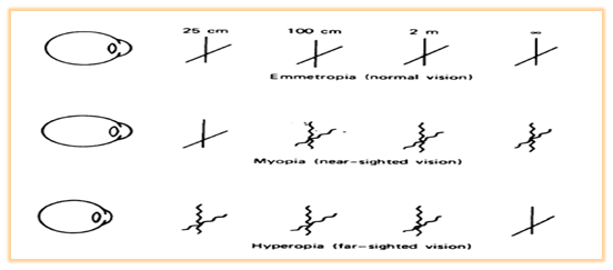 418_Ametropia-Defective eyesight due to focusing.png