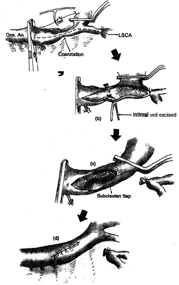 44_Subclavian flap aortoplasty.png