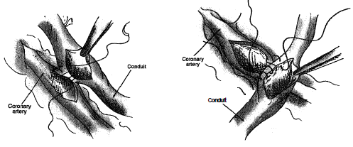 485_Conventional CABG on Cardiopulmonary Bypass.png