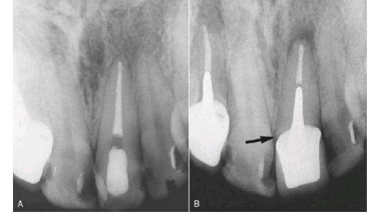 511_Explain the Radiographic Failure of Root Canal Treatment.png