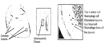 566_What are the phases to atherosclerosis.png