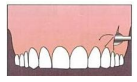 756_Define Reflection - Endodontic Surgery.png