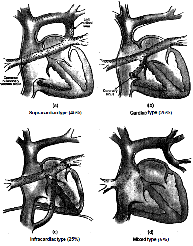 937_Total Anomalous pulmonary Venous Connection.png